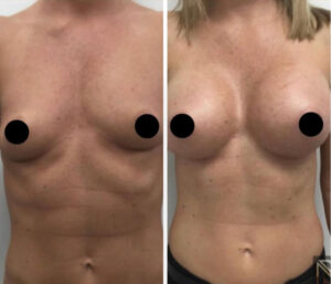 Breast Augmentation before and after photo