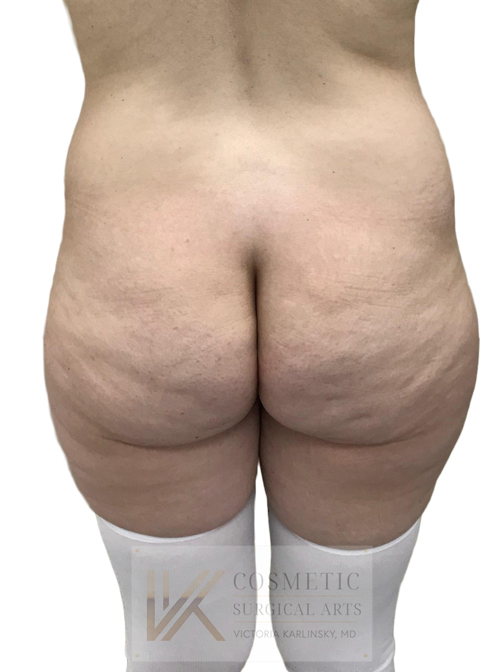 butt augmentation miami