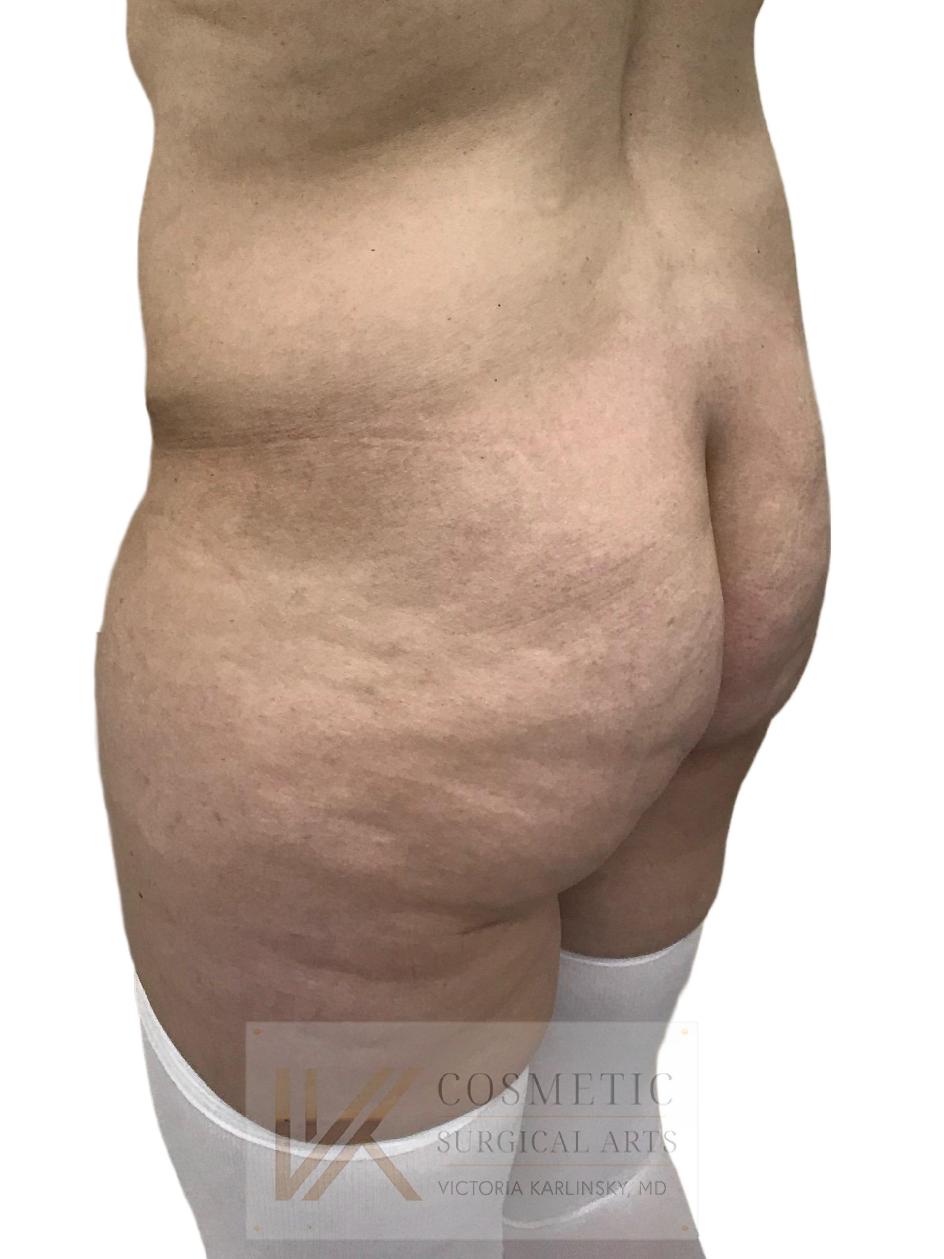 butt augmentation miami