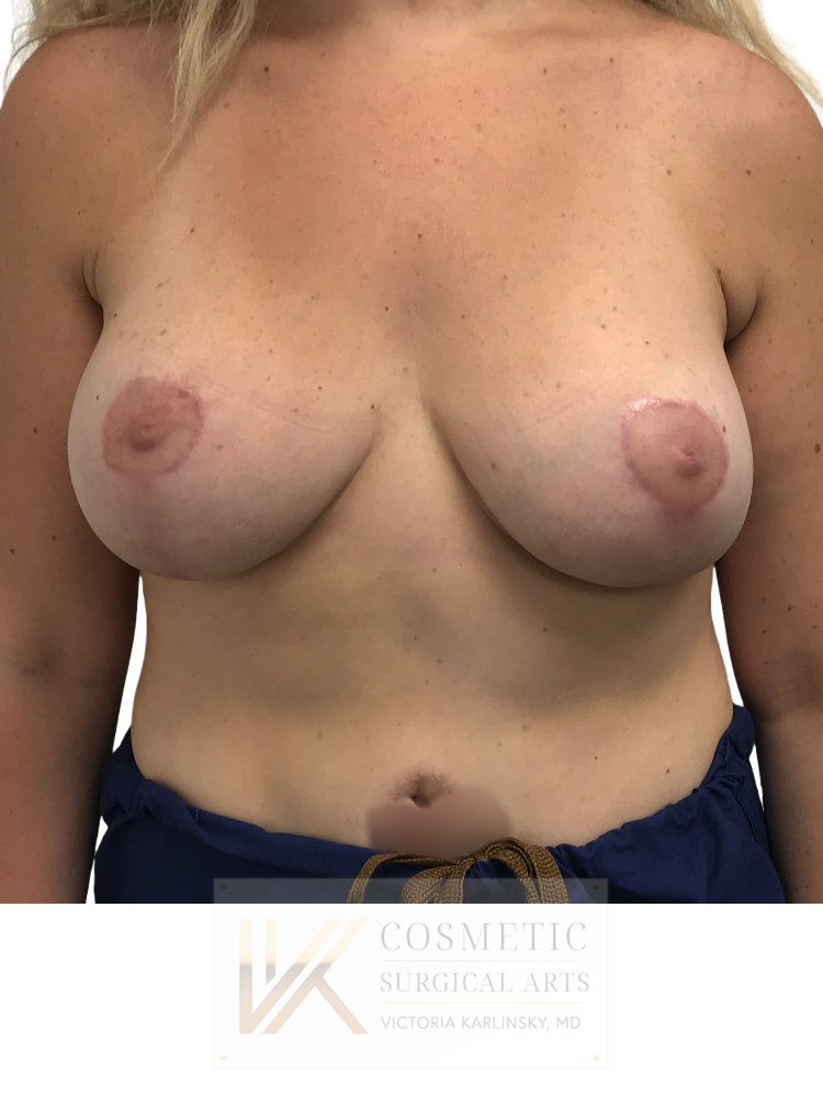 breast lift miami