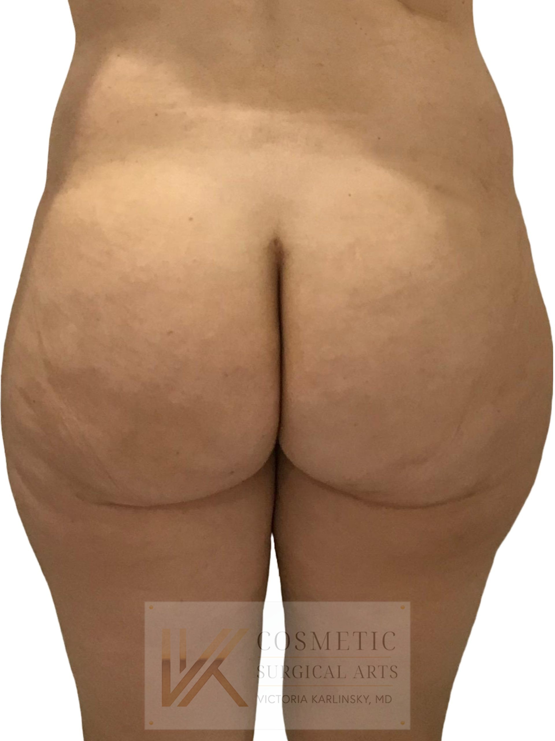 butt augmentation miami
