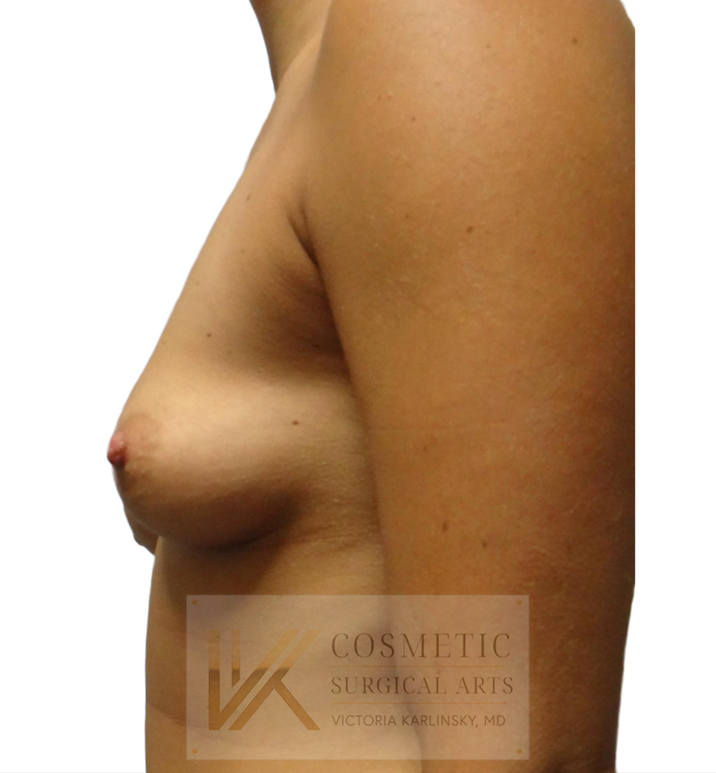 Case--4022---8211--Breast-Lift-with-Fat-Grafting | Before Breast 2
