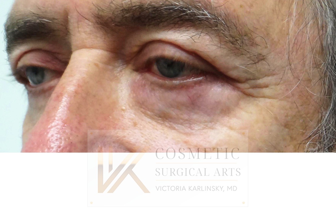 blepharoplasty miami 2