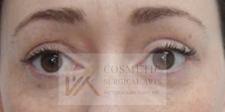 Case--3405---8211--Blepharoplasty | After Face 1