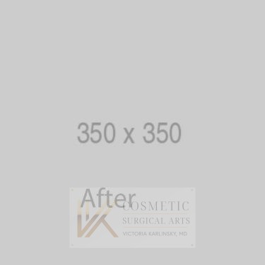 Tummy-Tuck-Patient-01 | After Body 1