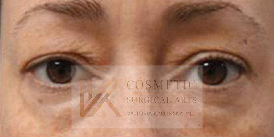 Case--3405---8211--Blepharoplasty | Before Face 1