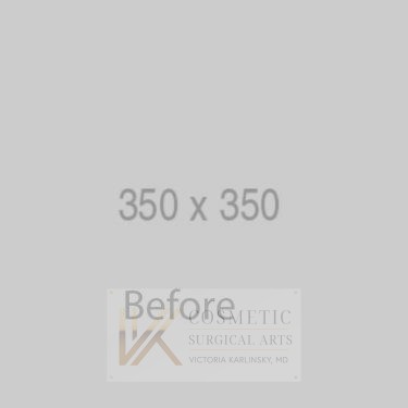 Tummy-Tuck-Patient-01 | Before Body 1