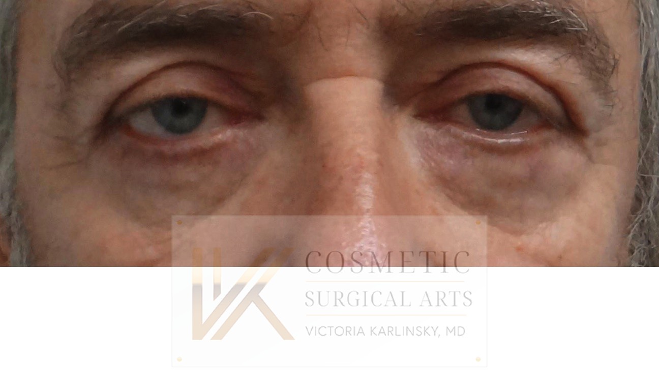 blepharoplasty miami 2