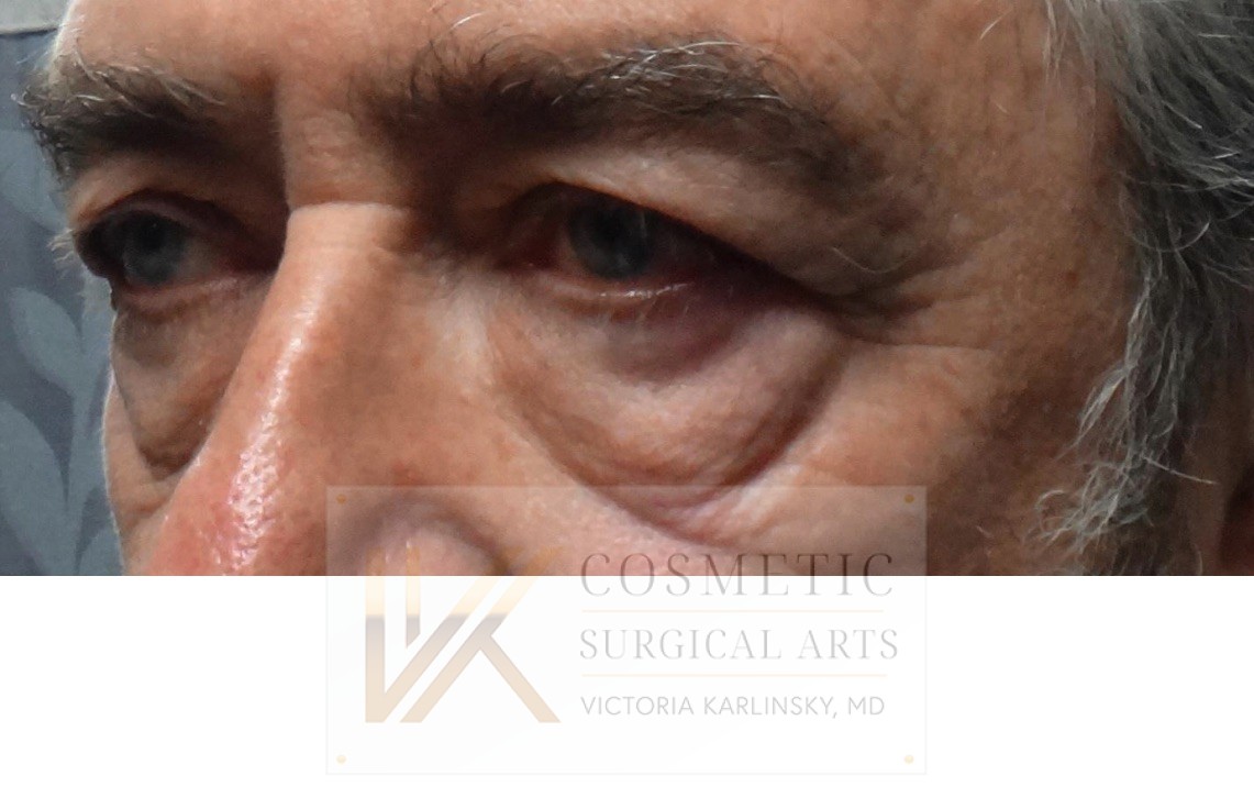 blepharoplasty miami 2