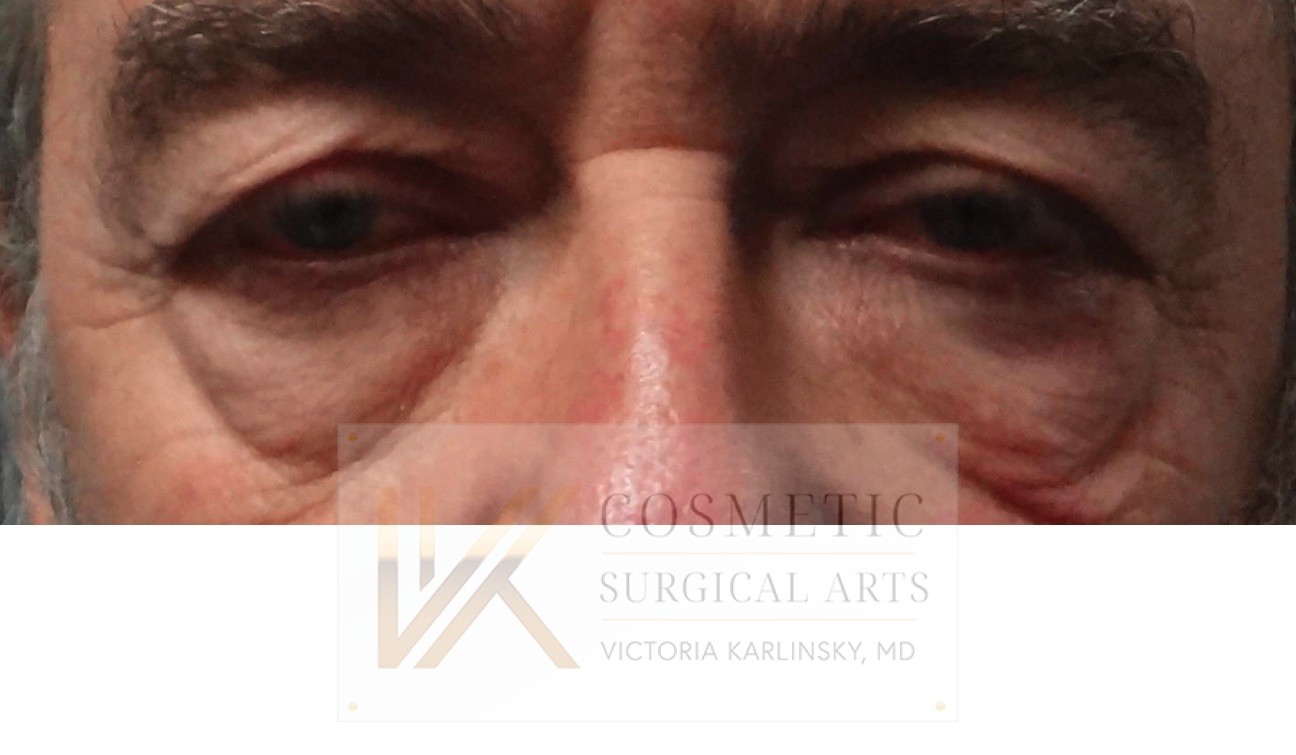 blepharoplasty miami 2
